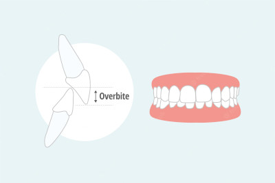 béance dentaire orthodontie