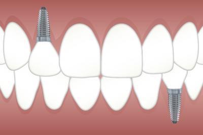 nettoyage implant dentaire saint-herblain